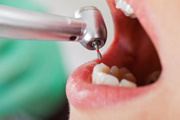 Best Emergency Dentist for Knocked-Out Tooth in Colesville, MD